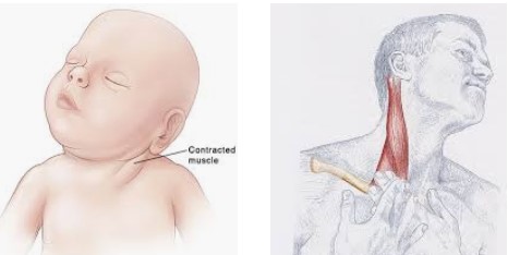 Esternocleidomastoideo (Sternocleidomastoideus) 2 acortamiento esternocleidomastoideo