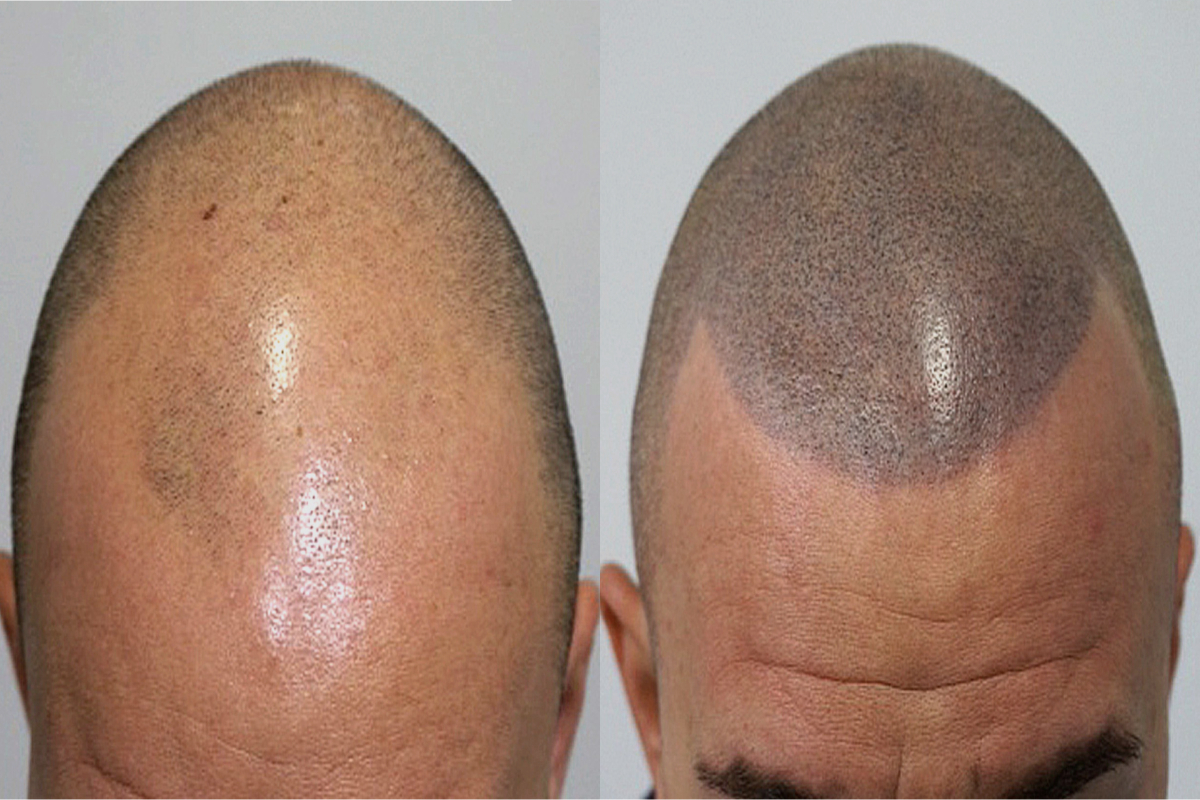 Antes y después de una micropigmentación capilar