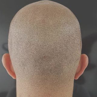 Micropigmentación capilar en un hombre