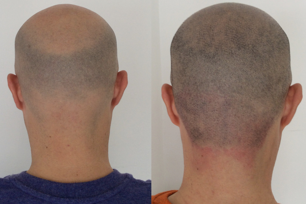 Tratamiento de micropigmentación capilar en hombre